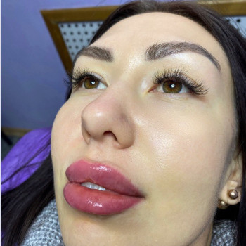 Повторная коррекция губ , суммарно 1,5 мл в губках