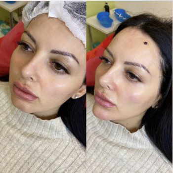 Була виконана корекція підборіддя, вилиць та «яблучок молодо».