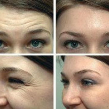 Ботулотоксин
                    Косметолог-ін'єкціоніст Лилия Київ