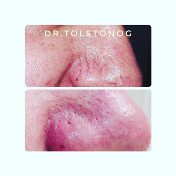 Удаление сосудов за одну процедуру.