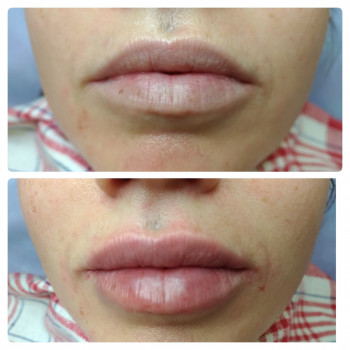 коррекция зоны губ