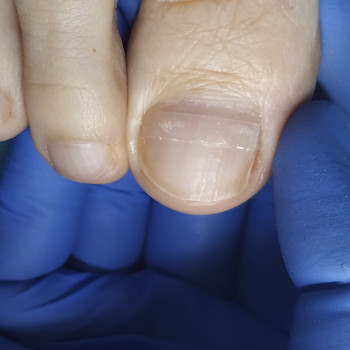 Установка корректирующей системы B/S пластины