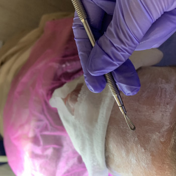 Чистка лиця мануальна, фото - салон краси Best