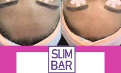 Hydrafacial Косметологічний центр Slimbar Київ