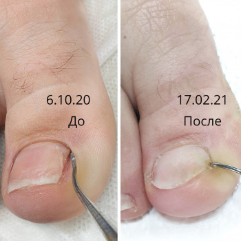 Восстановление ногтя после хирурга. С помощью титановой нити