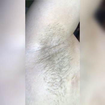 Подмышки до депиляции