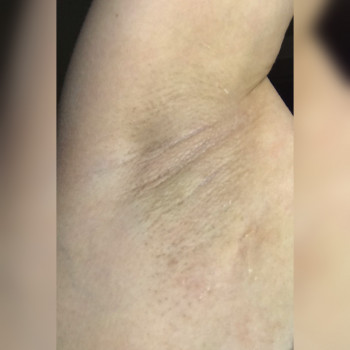 Подмышки после депиляции