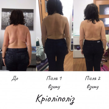 До и после процедуры криолиполиз!