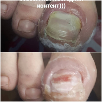 Удаление ногтя