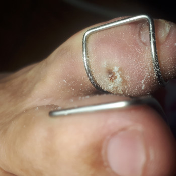 Удаление мозоли