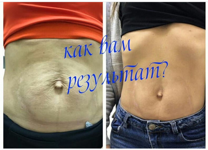 Результат после курса процедур (пилинг, липолитик, мезотерап, фото -  