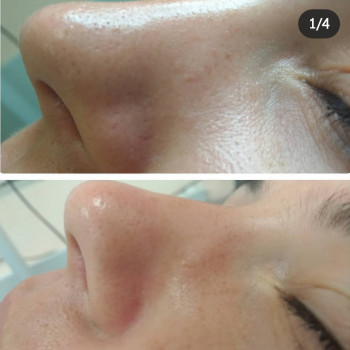 Комплексная чистка лица
                    Косметолог Элла Одесса