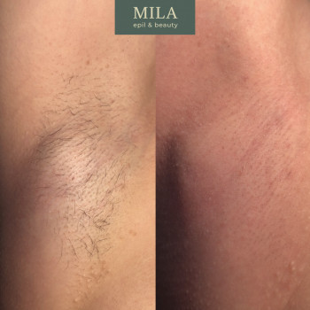 Электроэпиляция
                    Майстер депіляції Lucy Харків