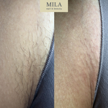 Электроэпиляция
                    Майстер депіляції Lucy Харків