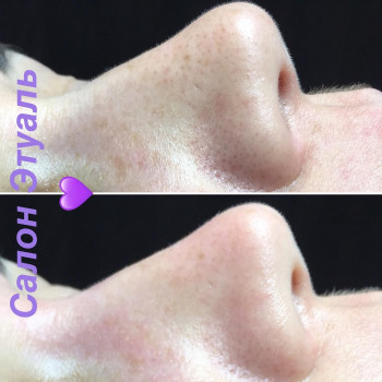 Чистка лица
                    Косметологический центр Этуаль Одесса