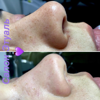 Чистка лица
                    Косметологический центр Этуаль Одесса