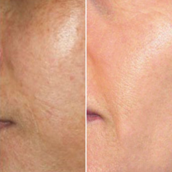 Пилинг химический
                    Косметологический центр Этуаль Одесса