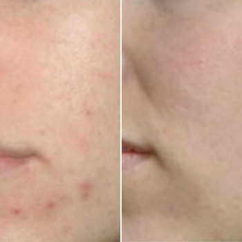 Пилинг химический
                    Косметологический центр Этуаль Одесса