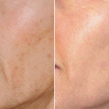 Пилинг химический
                    Косметологический центр Этуаль Одесса