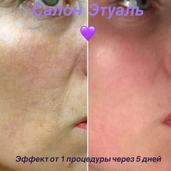 Микронидлинг - фракционная мезотерапия
                    Косметологічний центр Этуаль Одеса