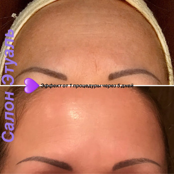 Микронидлинг - фракционная мезотерапия
                    Косметологічний центр Этуаль Одеса