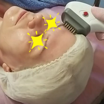 Комплекс "Фракционный RF-лифтинг" лица БЕЗ проколов кожи
                    Косметолог Ирина Киев