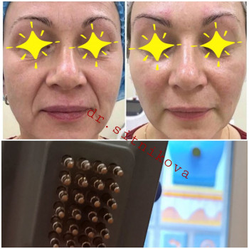 Комплекс "Фракционный RF-лифтинг" лица БЕЗ проколов кожи
                    Косметолог Ирина Киев