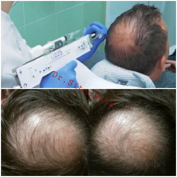 Мезотерапия для роста волос
                    Косметолог Ирина Київ