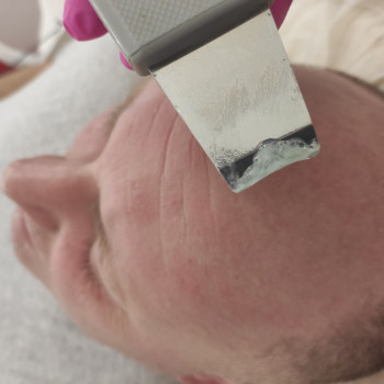 Ультразвукова чистка шкіри голови у чоловіків