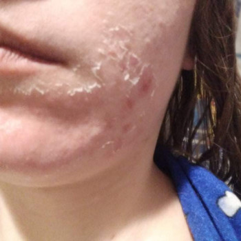 Відновлення шкіри обличчя після хімічного пілінгу