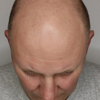 Ультразвукова чистка голови та обличчя у чоловіків