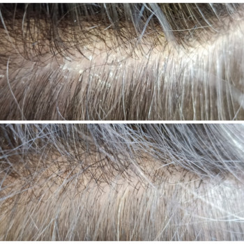 Пилинг кожи головы
                    Парикмахер-колорист Ирина Киев