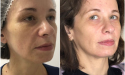 Векторний ліфтинг RADIESSE Косметологічний центр O.L.Beauty Київ