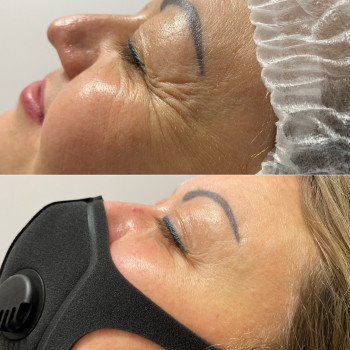 Ботулінотерапія( зона очей)