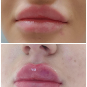 Контурна пластика
                    Лікар-косметолог Тетяна Луцьк