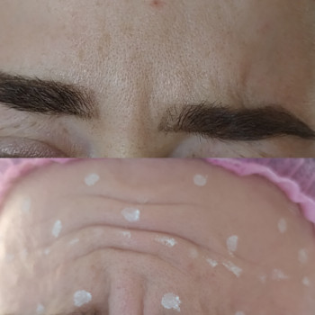 Ботулінотерапія
                    Лікар-косметолог Тетяна Луцьк