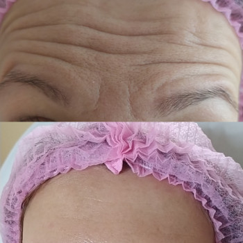 Ботулінотерапія
                    Лікар-косметолог Тетяна Луцьк