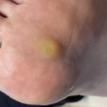 Видалення стержневої мозолі
                    Подолог Лілія Черкассы