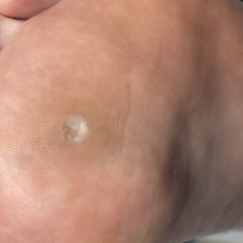 Видалення стержневої мозолі
                    Подолог Лілія Черкассы