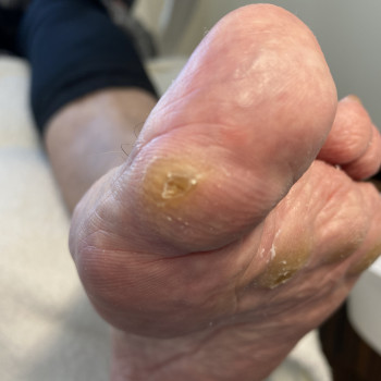 Видалення стержневої мозолі
                    Подолог Лілія Черкассы