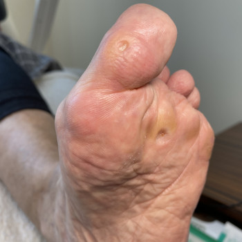 Видалення стержневої мозолі
                    Подолог Лілія Черкассы