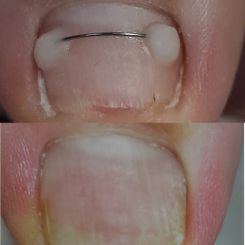 Коррекція врослого нігтя
                    Подолог Татьяна Викторовна Запорожье