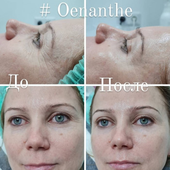 Oenante - пилинг-биоревитализант с эффектом  лифтинга
                    Косметолог Оксана Киев