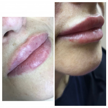 Увеличение губ
                    Врач-косметолог Карина Харьков