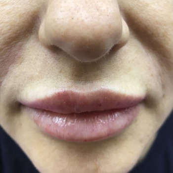 Увеличение губ
                    Врач-косметолог Карина Харьков