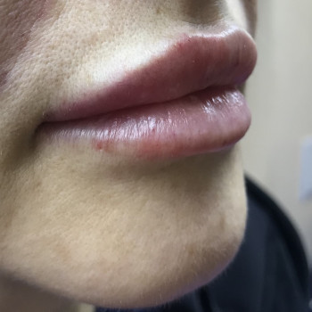 Увеличение губ
                    Врач-косметолог Карина Харьков