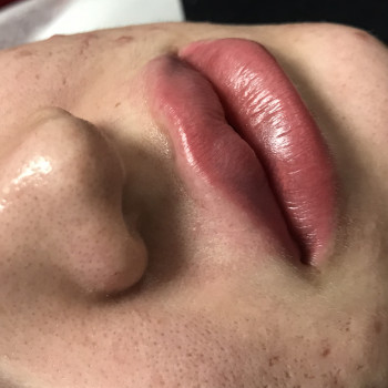 Увеличение губ
                    Врач-косметолог Карина Харьков