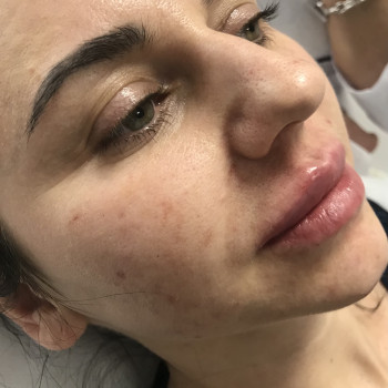 Увеличение губ
                    Врач-косметолог Карина Харьков