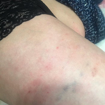 Липолитики
                    Врач-косметолог Карина Харьков