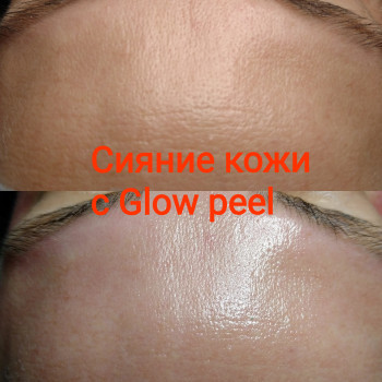 Пилинг"сияние кожи"